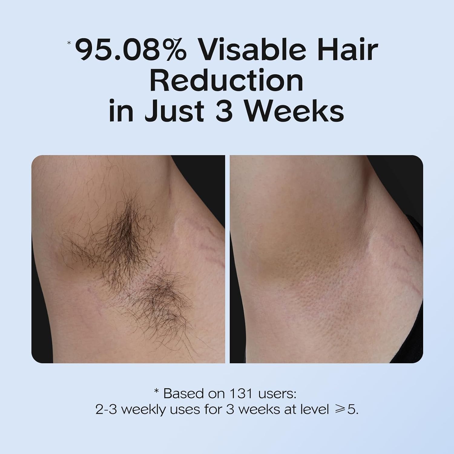 INNZA IPL Hair Removal with Ice Cooling Care Function for Women,Long-Lasting Results,999,999 Flashes Painless Hair Removal, Hair Removal Device for Armpits Legs Arms Bikini Line - Image 3