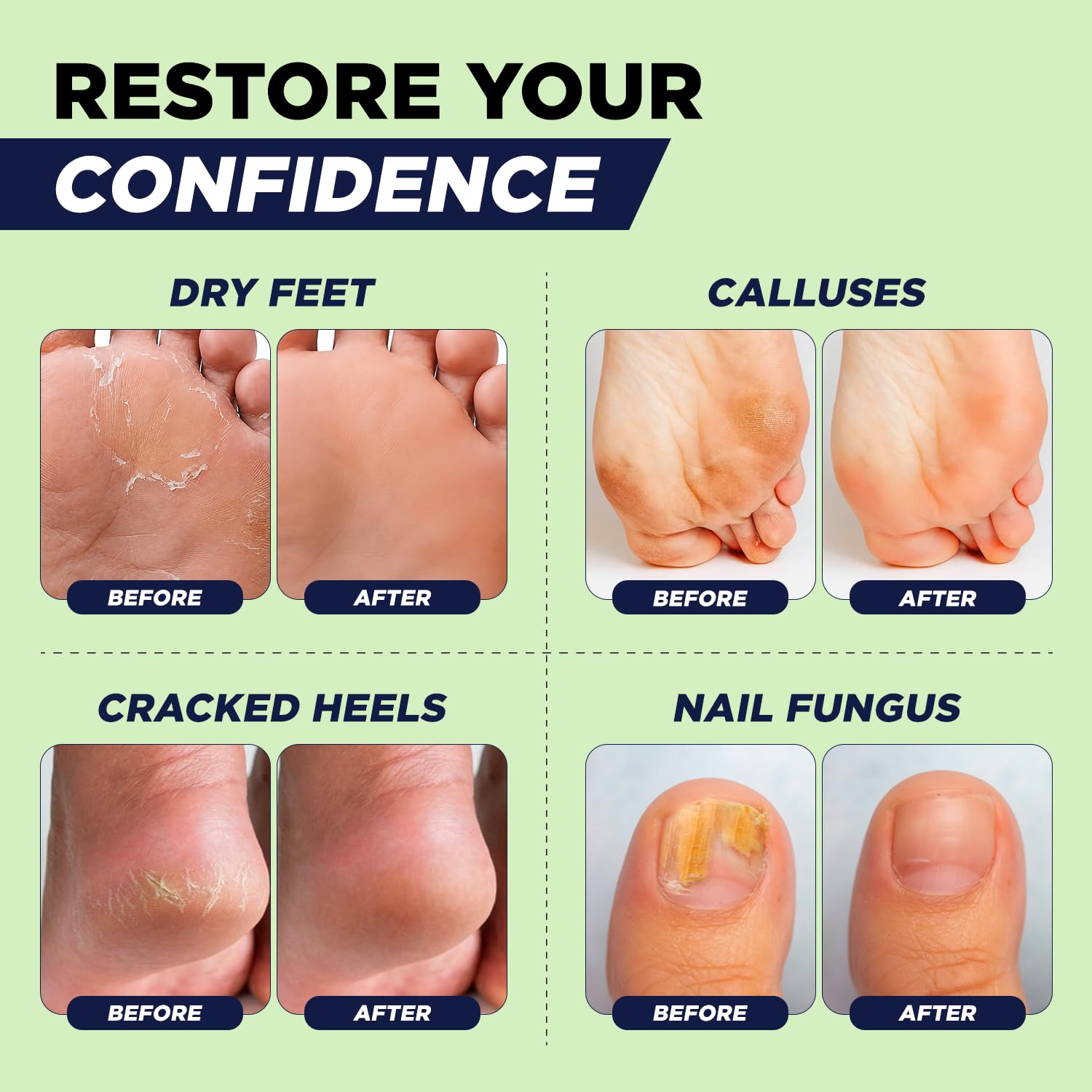 Tea Tree Callus Remover Gel & Foot Soak, Foot Cream for Dry Cracked Feet | Extra Strength Callus Remover Gel kit for Dry Cracked Heels, Foot Cream Hydrate Softens Calluses & Rough Skin - 4in1 - Image 5